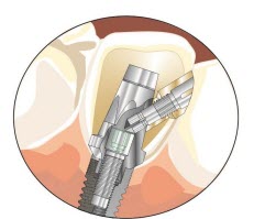 schroefrichting implantaat
