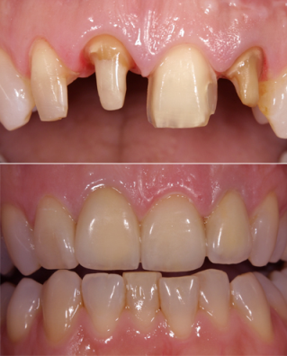 sakura: kroon naast veneer